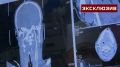Врачи госпиталя Вишневского извлекли осколок снаряда из сонной артерии бойца СВО